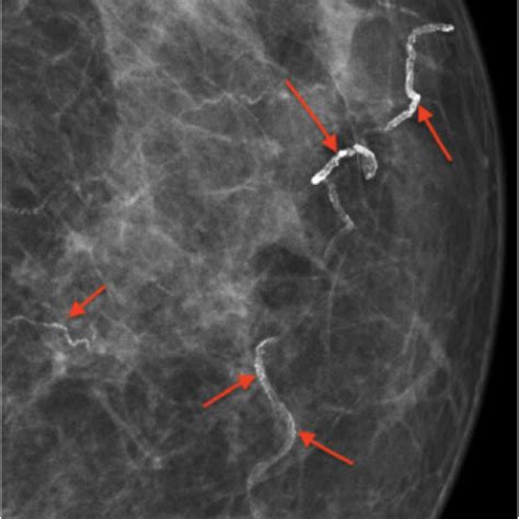 Mammogram Image Showing A High Grade Of Calcification Red Arrows Download Scientific Diagram