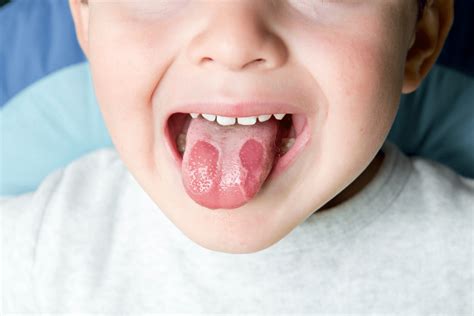 Mungesa E Vitaminës B12 Tri Simptoma Të Veçanta Që Gjenden Në Gojën