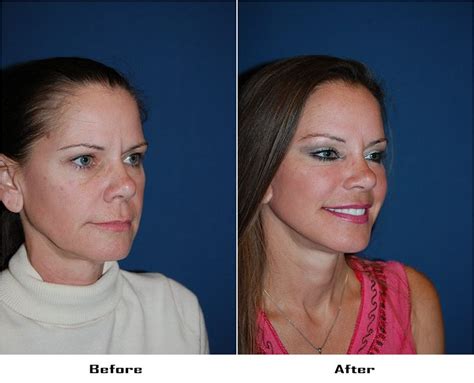 Brow lift surgery in mexico typically lasts from 1 to 2 hours and is generally performed under either. Procedures Performed: Endoscopic Brow Lift: Asymetric Brow ...