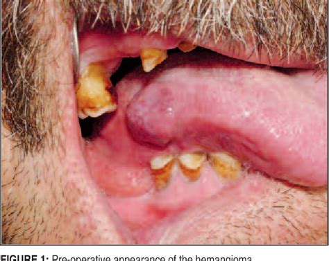 Figure 1 From Surgical Treatment Of Tongue Hemangioma With Diode Laser