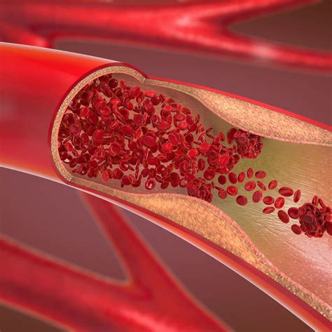 What Does A Blood Clot Feel Like 8 Signs You Should Never Ignore Artofit