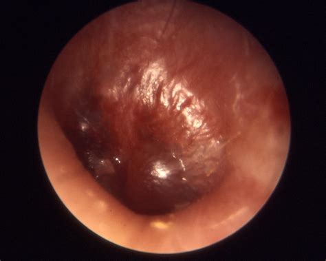 Otitis Media Middle Ear Infection Causes Symptoms Treatment Otitis