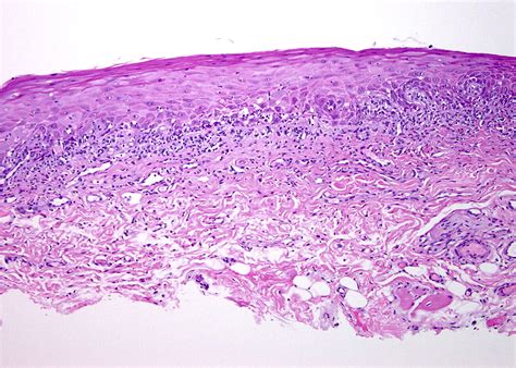 The Lichenoid Tissue Reactions Of The Oral Mucosa Oral Lichen Planus