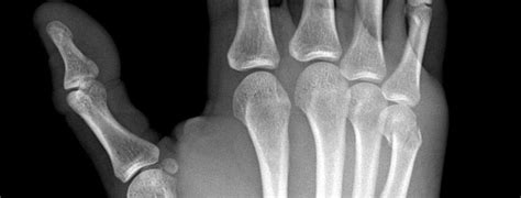 An X Ray Of My Broken Hand Jim On Light