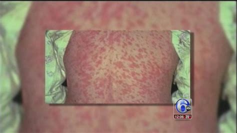 Concerns Grow Across Country Over Measles Outbreak