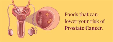 How To Prevent Prostate Cancer Rela Hospital