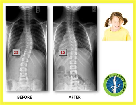 Early Stage Scoliosis Take Action To Prevent Scoliosis From Getting Worse Treating Scoliosis