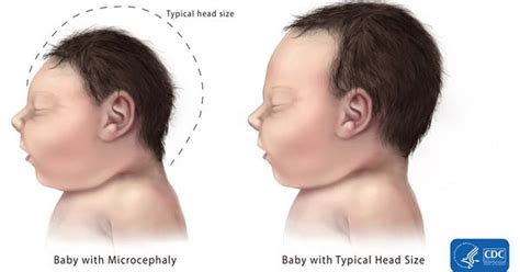 New Estimate Shows Frequency Of Zika Associated Birth Defects In Us