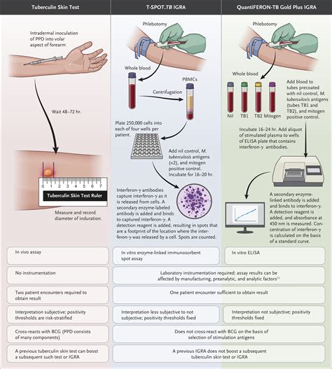 Latent Tuberculosis Infection Nejm