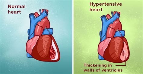 8 Powerful Home Remedies For Hypertension