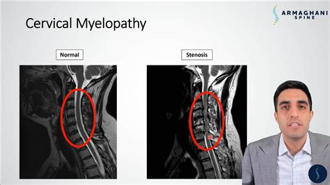 Cervical Myelopathy What Is It How Can We Treat It YouTube