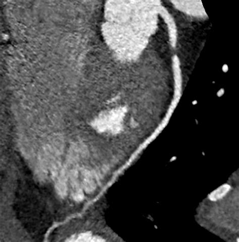 As a result, these coronary arteries become narrowed and, sometimes, completely blocked off. The status of cardiac CT - Medical Forum