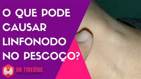 O que pode causar linfonodo no pescoço Dr Jônatas Catunda YouTube