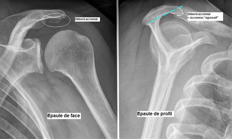 The morphology of the acromion and its relationship to rotator cuff tears. Conflit sous acromial | epaule Toulouse