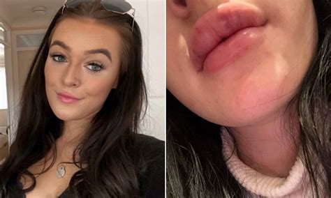 Woman Left Unable To Close Her Own Mouth After Lip Filler Surgery