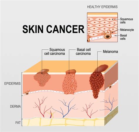 Skin Cancer Body Map