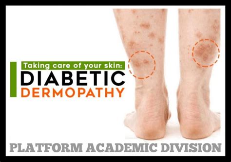 Diabetic Shin Spots Diabetic Dermopathy Platform Cme