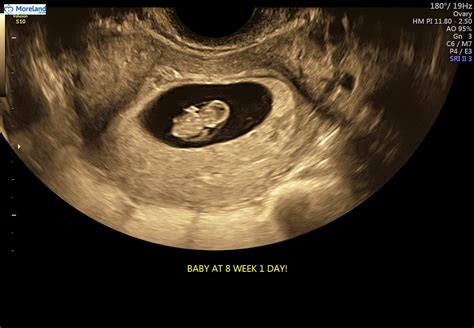 7 Weeks 5 Day Ultrasound Anyone Close October 2019 Babies