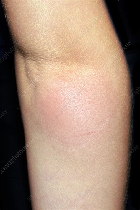 Allergic Reaction To Mosquito Bite Stock Image C Science Photo Library