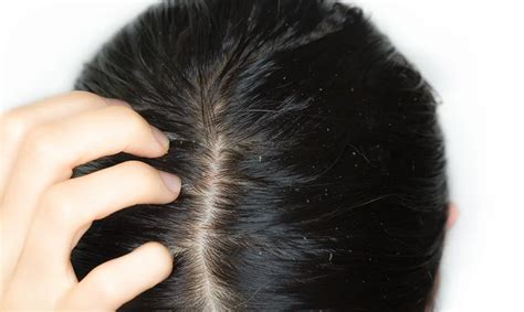 Seborrheic Dermatitis Scalp Hair Loss