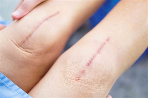 Healing Your Scabs After Surgery