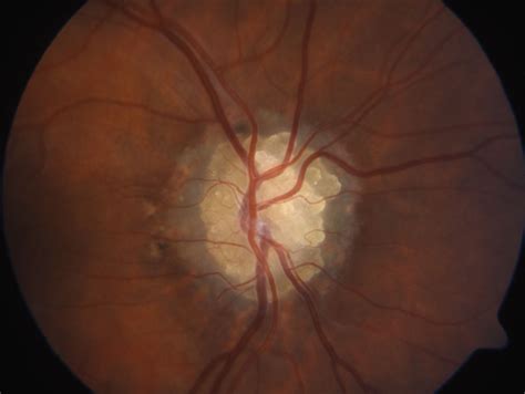 Oct Angiography In Optic Disc Drusen Comparison With Structural And