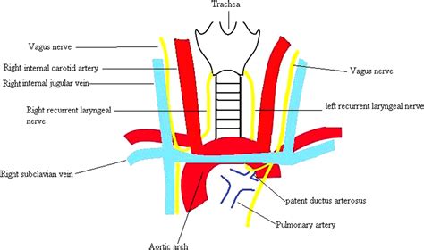 Vocal Cord Paralysis After Cardiac Surgery And Interventions A Review