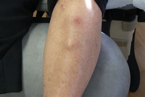 Painful Shin Lesions Described As Bumps Clinical Advisor