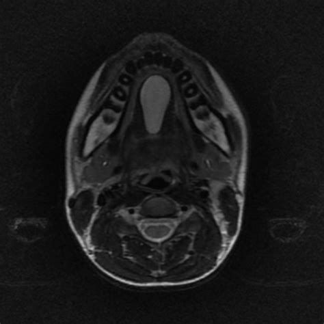 Dermoid Cyst Of Floor Of Mouth Image