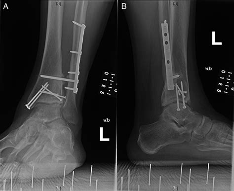 Irreducible Ankle Fracture Dislocation Due To Tibialis Anterior