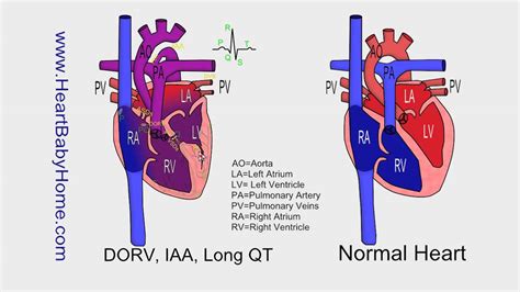 65 Dorv Interrupted Aortic Arch Long Qt Williams Syndrome Youtube
