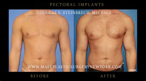 Pectoral Implants Male Plastic Surgery Chicago