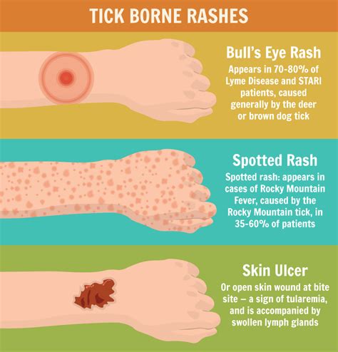 How To Prevent And Manage Tick Bites Infographic The Nols Blog