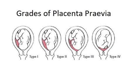 Placenta previa is related to severe maternal and fetal morbidity. What is Placenta Praevia and how could it affect your ...