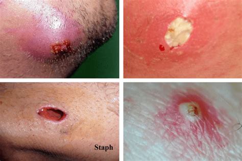 Infected Ingrown Hair Causes Pictures Cysts Staph Treatment Removal On Leg Groin Face Vag