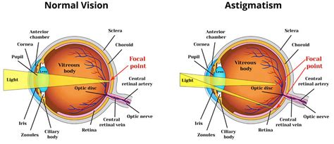 Children play/are playing football in the park now. What is Astigmatism - Causes, Symptoms,Treatment