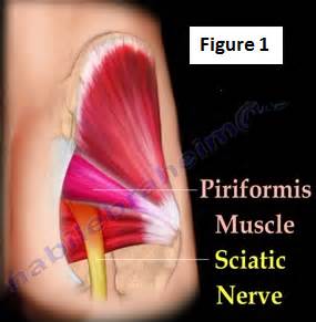 Only a person who's experienced piriformis syndrome (like me) can comprehend how hard it is to live with this chronic. Piriformis Syndrome | HuffPost