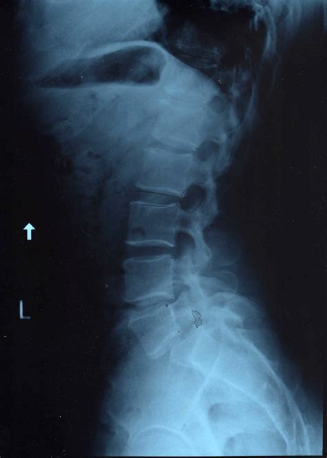 Read about cervical spondylosis, which is the medical term for neck pain caused by this is called cervical spondylosis. Xray-Keith-Spondylosis-1.jpg | Here is an X-ray of my L5 ...