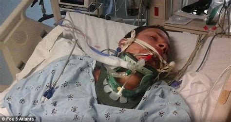 James Lauria Put In A Coma After His E Cigarette Exploded In His Hand
