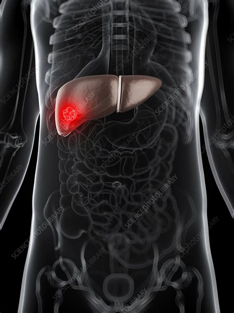 Liver Cancer Artwork Stock Image F006 7948 Science Photo Library