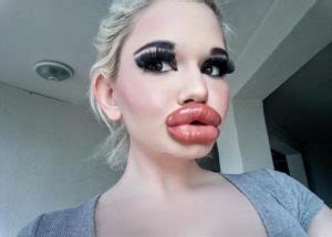 Real Life Barbie With Biggest Lips In The World Shares Photos After