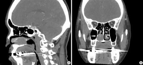 Coronal And Sagittal Ct Of The Paranasal Sinus Shows Open I