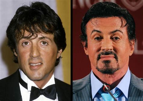 Sylvester Stallone Plastic Surgery Corrected Sagging Face