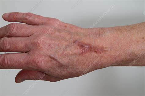 Skin Burn Stock Image C0221617 Science Photo Library