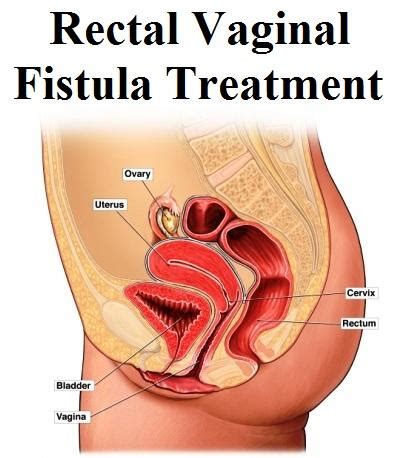 Rectal Vaginal Fistula Treatment Market Is Predicted