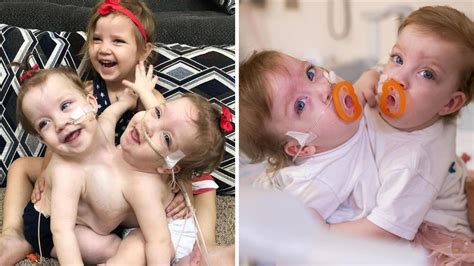 Michigan Conjoined Twins Sarabeth And Amelia Thrive After Separation