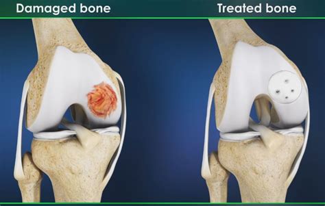 Knee Cartilage Pain Causes Treatments And Prevention Brandon Orthopedics