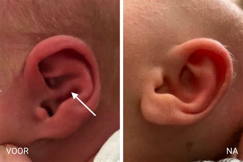 Earwelleu Ear Correction For Infant Ear Deformities