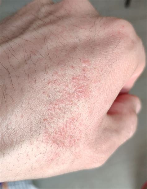 Сыпь на руке и сухость кожи рук Вопрос дерматологу 03 Онлайн