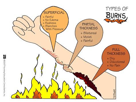 Types Of Burns Superficial Partial Thickness Full Thickness